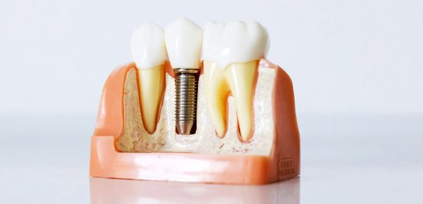 clinica-dental-dr-bordes-lleida-implantes-dentales